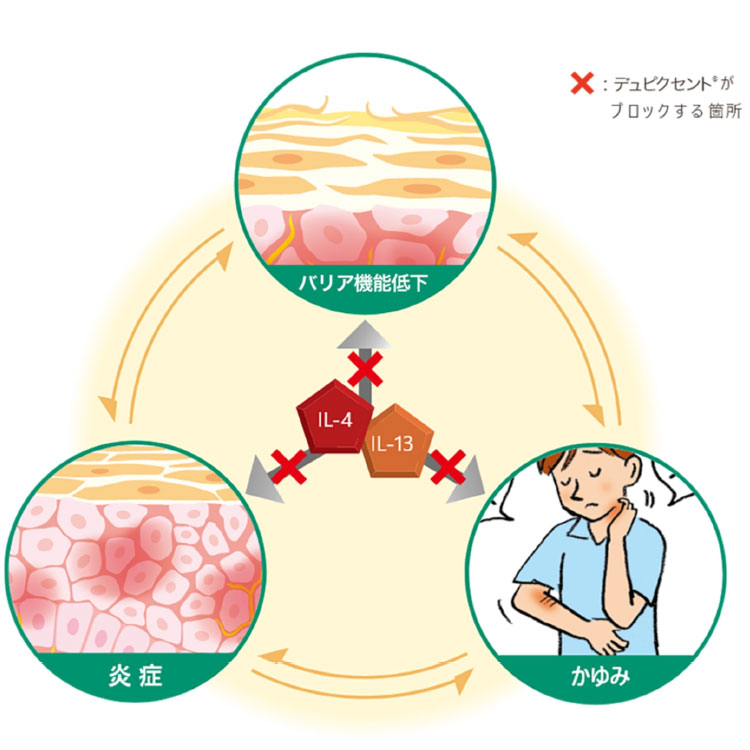 アトピー性皮膚炎の仕組み